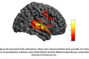 Científicos encuentran signos de reorganización cerebral en epilepsia