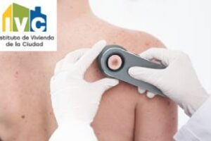 Barrios 15 y 20:Comienza campaña de prevención del cáncer de piel